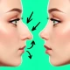 Rinoplasti - Fotoğraf Editörü