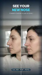 Nose Job - Plastic Surgery AI 1