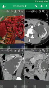 DroidRender - 3D DICOM viewer screenshot