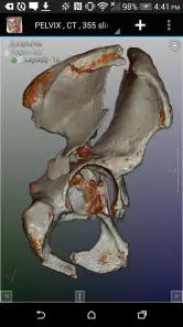 DroidRender - 3D DICOM viewer screenshot